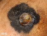 melanoma
