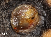 melanoma