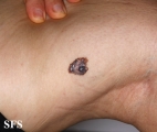 melanoma