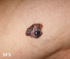 melanoma