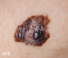 melanoma