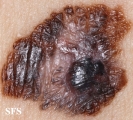 melanoma