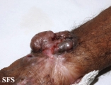 melanoma