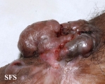melanoma