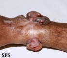 melanoma