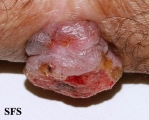 melanoma