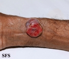 melanoma