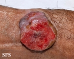 melanoma