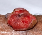 melanoma