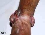 melanoma