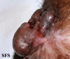 melanoma