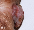 melanoma
