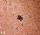 melanoma