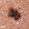 melanoma