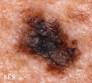 melanoma