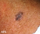 melanoma