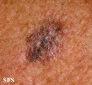 melanoma