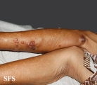 melanoma