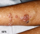 melanoma