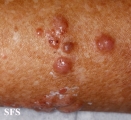 melanoma