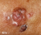 melanoma