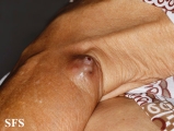 melanoma
