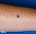 melanoma