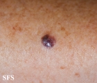 melanoma