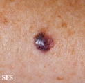 melanoma
