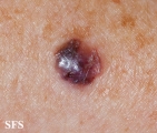 melanoma