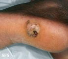 melanoma