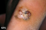 melanoma