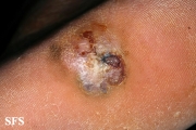 melanoma