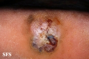 melanoma