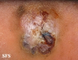 melanoma