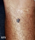melanoma