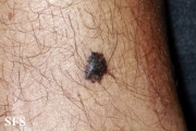 melanoma