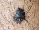 melanoma