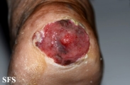 melanoma