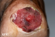 melanoma