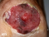 melanoma