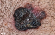 melanoma