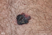 melanoma
