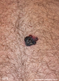 melanoma