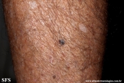 melanoma