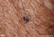 melanoma
