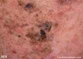 melanoma