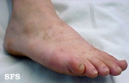 naevus achromic
