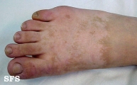 naevus achromic