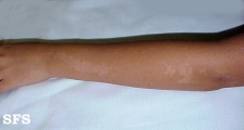 naevus achromic